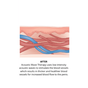 After - Thin Blood Vessel