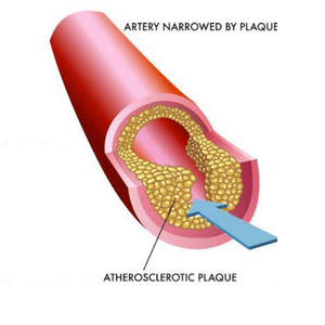 Artherosclerotic artery